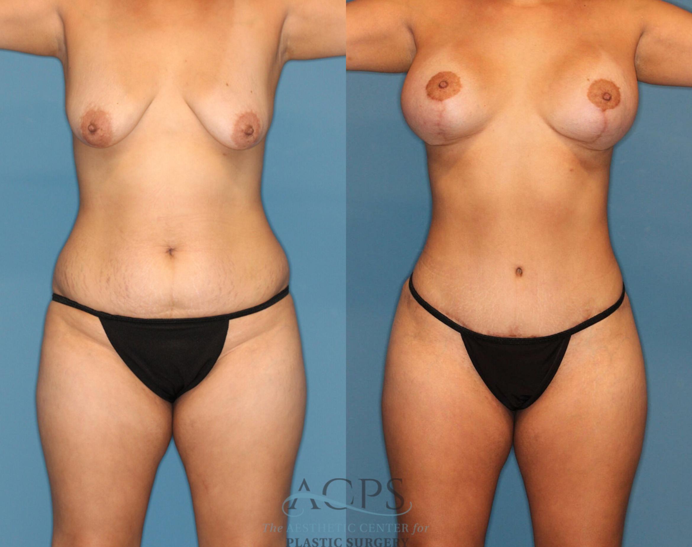 Before & After Liposuction Case 189 Front View: View in Houston, TX