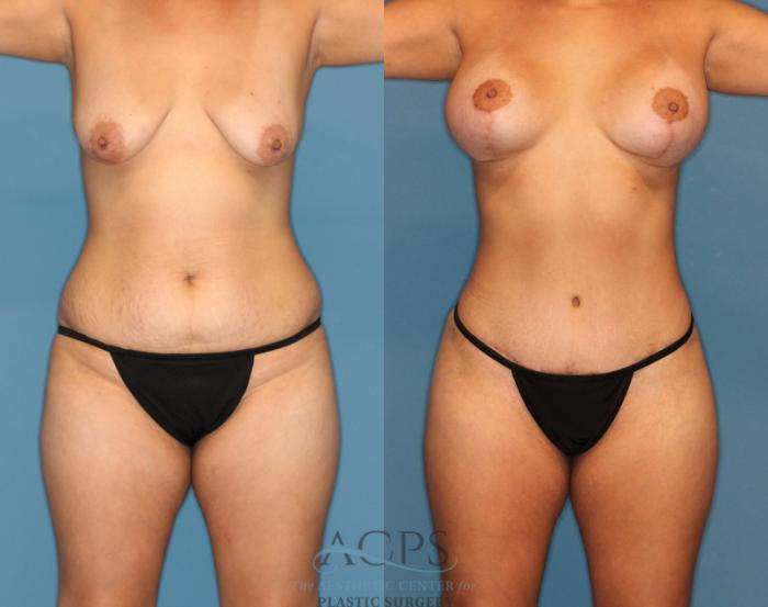 Before & After Liposuction Case 189 Front View: View in Houston, TX