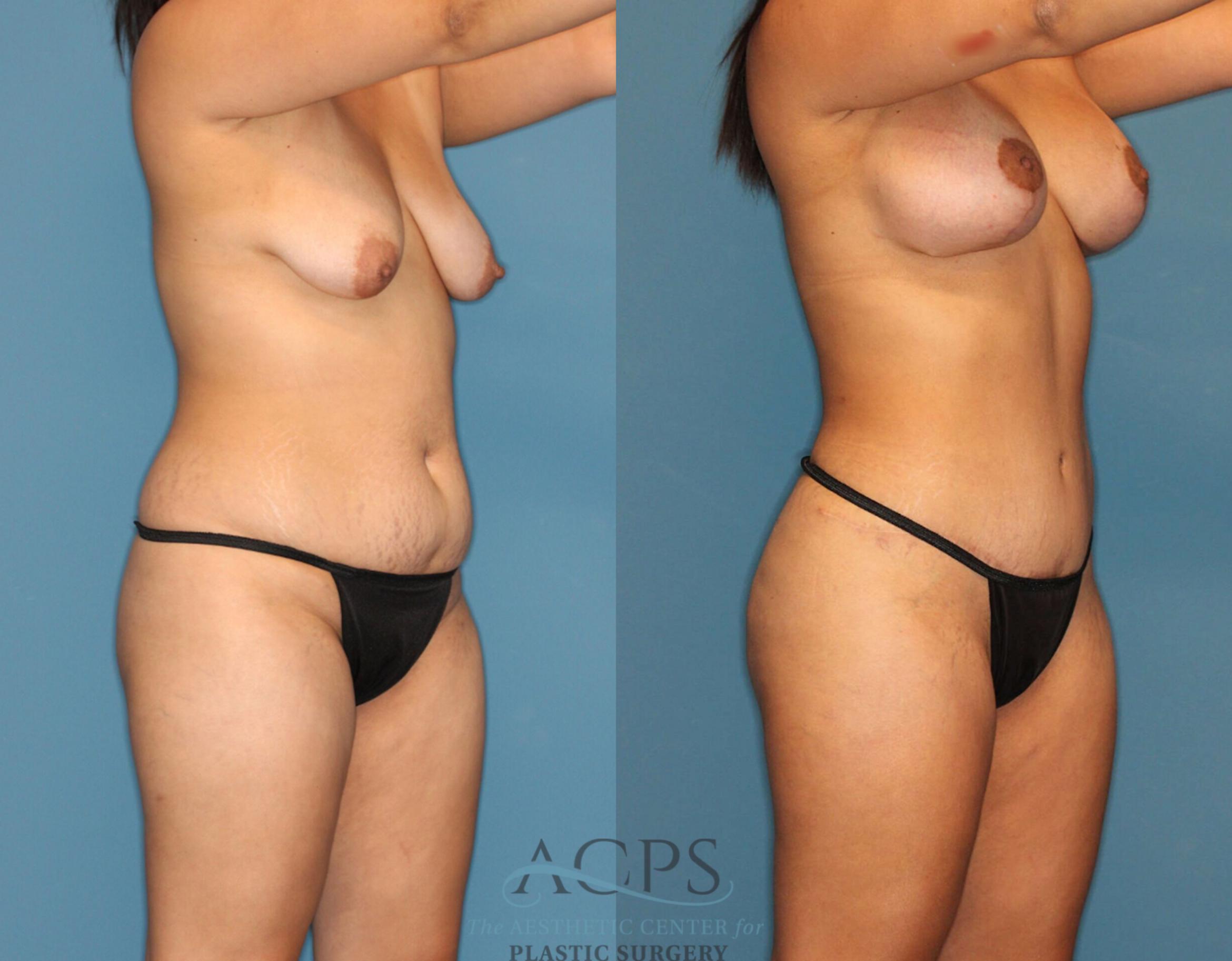 Before & After Liposuction Case 189 Oblique View: View in Houston, TX