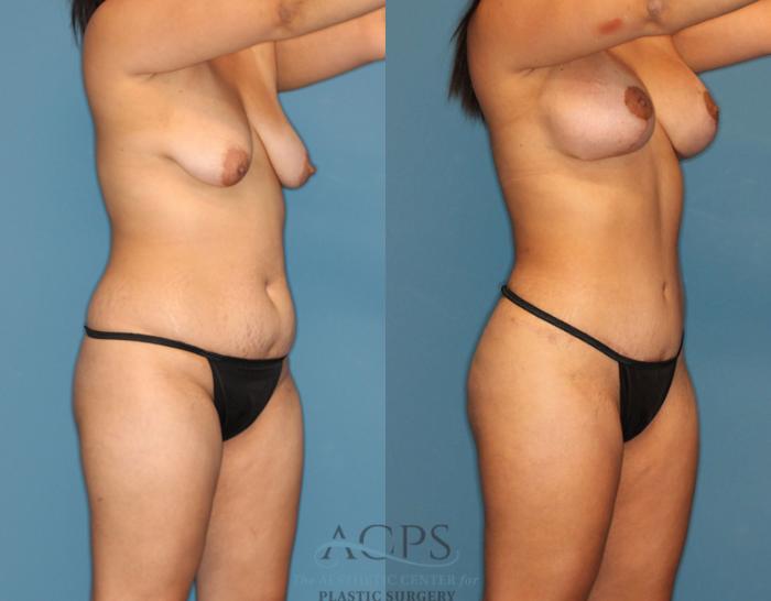 Before & After Liposuction Case 189 Oblique View: View in Houston, TX
