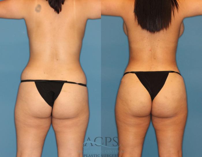 Before & After Liposuction Case 189 Rear View: View in Houston, TX