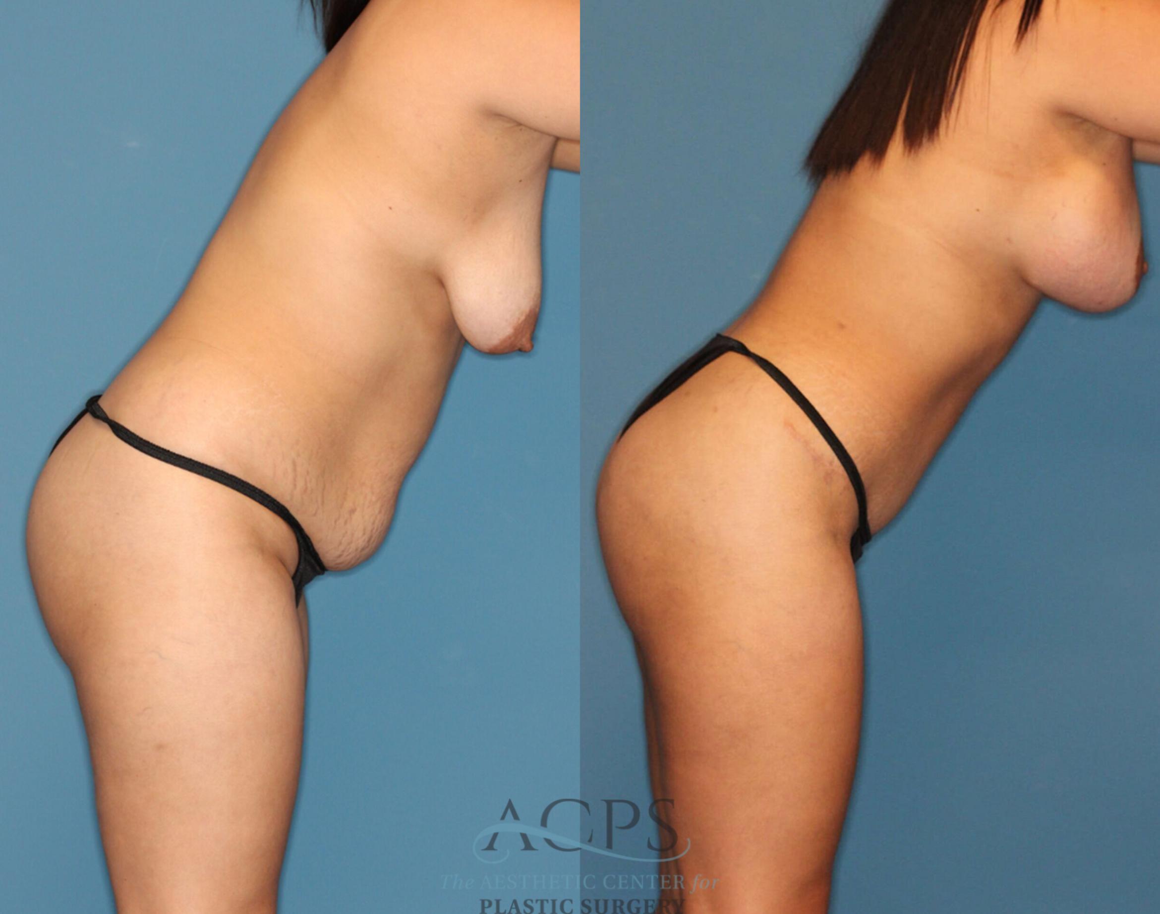 Before & After Liposuction Case 189 Right Side Bend View: View in Houston, TX