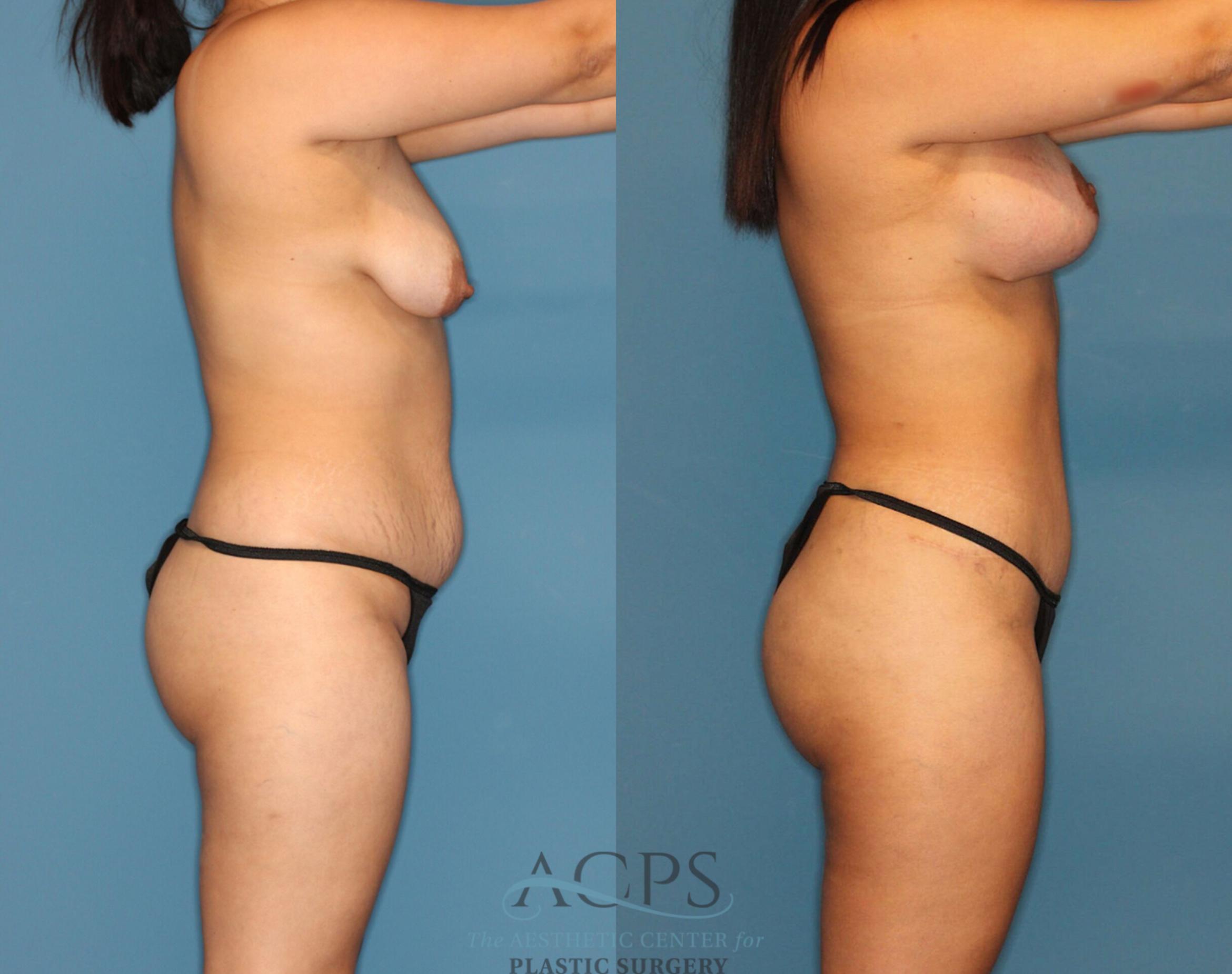 Before & After Liposuction Case 189 Right Side View: View in Houston, TX