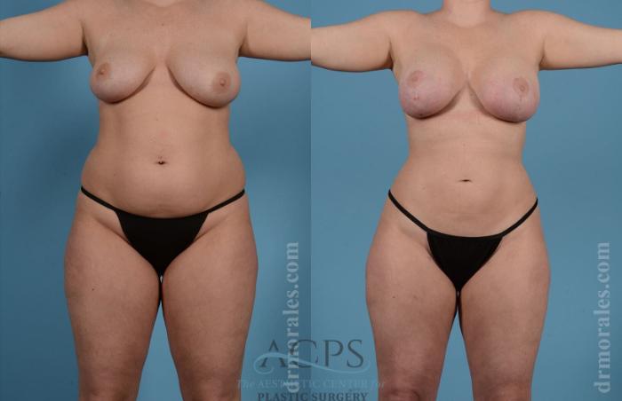 Before & After Liposuction Case 190 Front View: View in Houston, TX