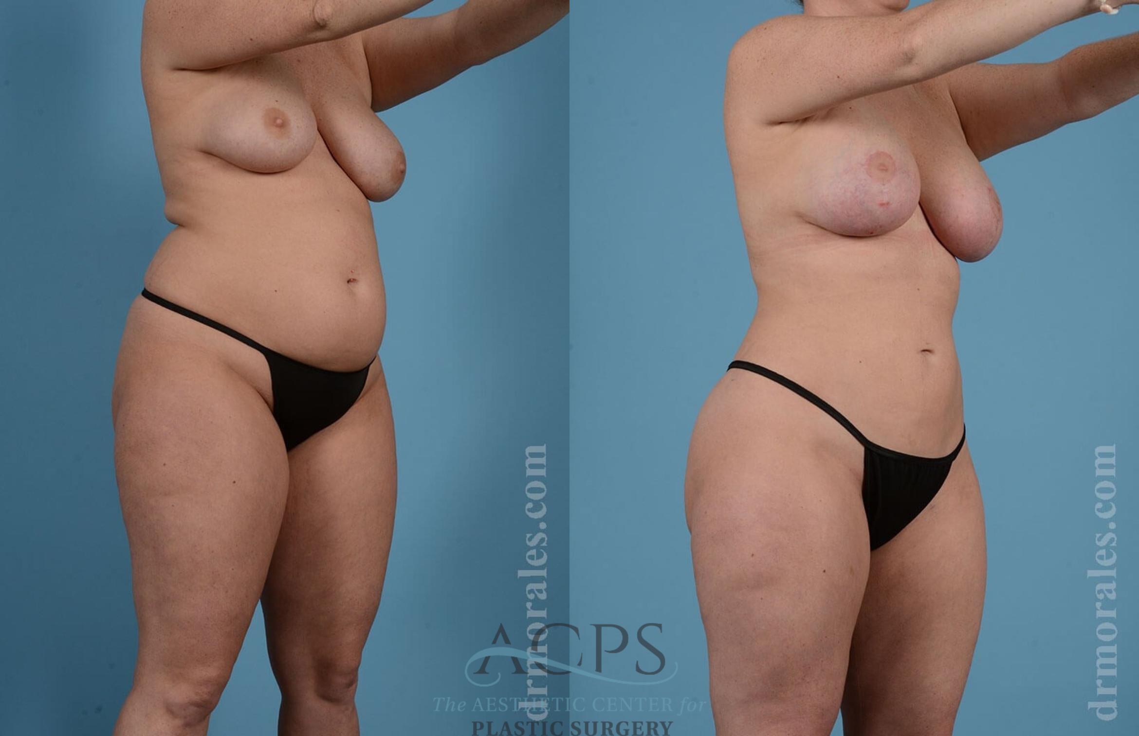 Before & After Liposuction Case 190 Oblique View: View in Houston, TX