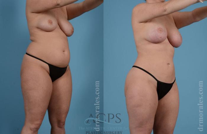 Before & After Liposuction Case 190 Oblique View: View in Houston, TX