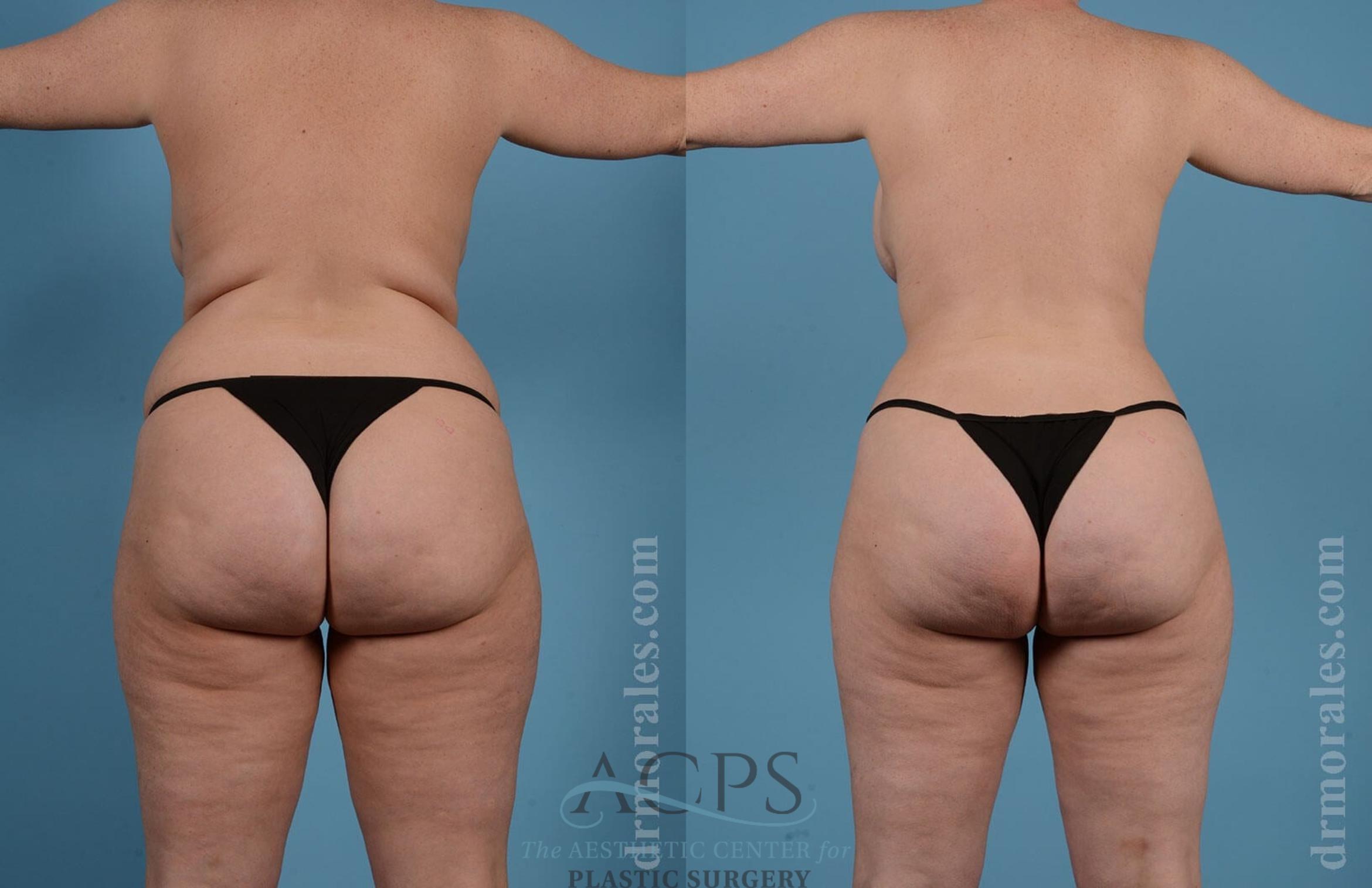 Before & After Liposuction Case 190 Rear View: View in Houston, TX