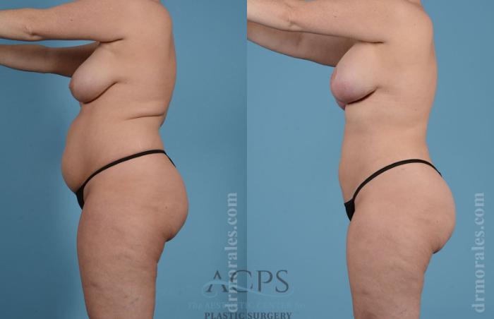 Before & After Liposuction Case 190 Side View: View in Houston, TX