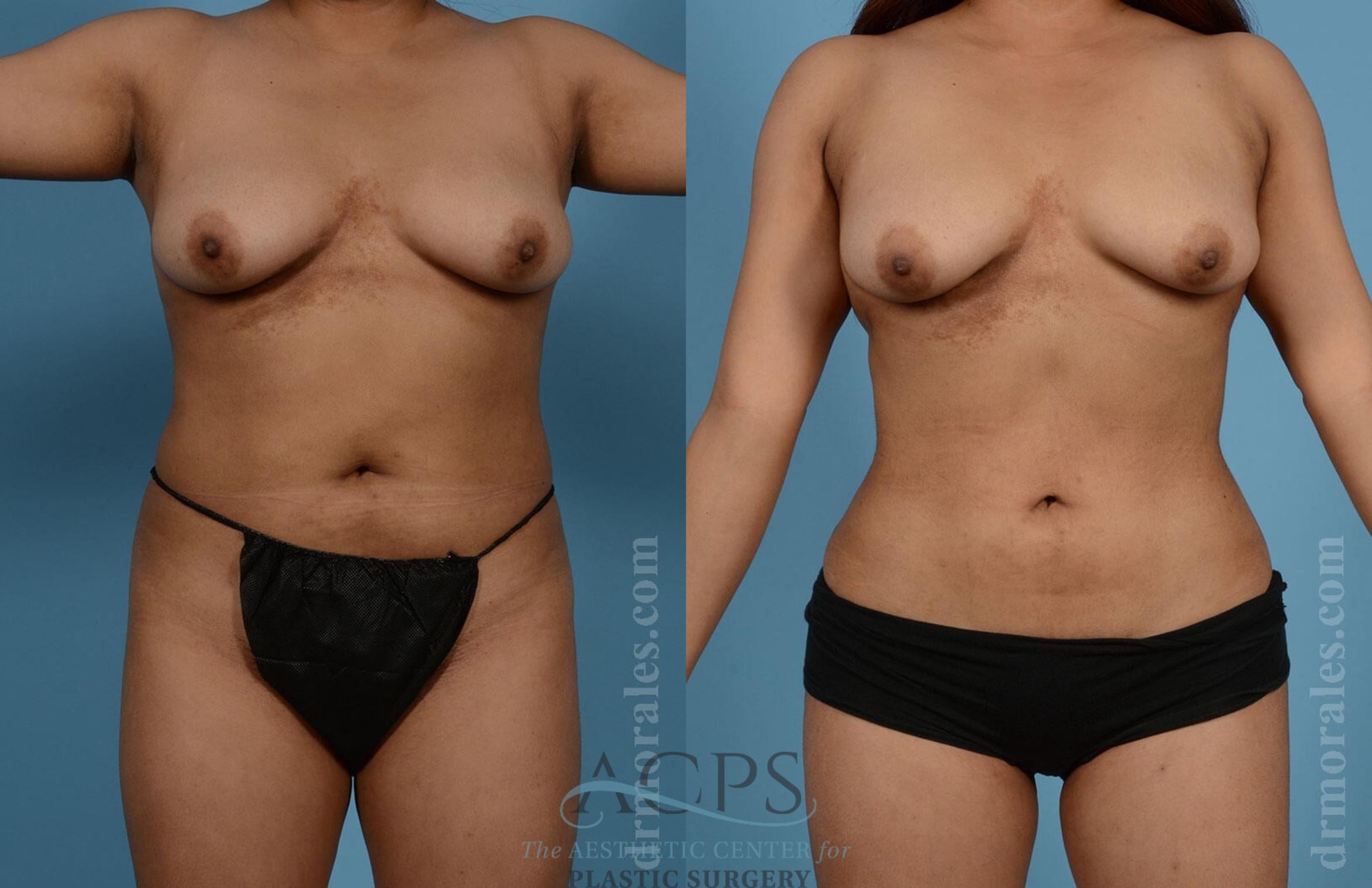 Before & After Liposuction Case 191 Front View: View in Houston, TX