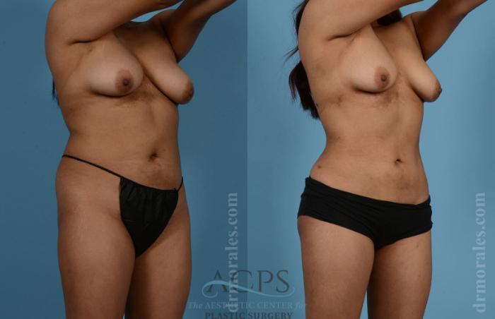 Before & After Liposuction Case 191 Oblique View: View in Houston, TX