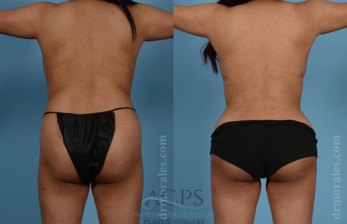 Before & After Liposuction Case 191 Rear View: View in Houston, TX