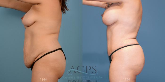 Before & After Liposuction Case 192 Side View: View in Houston, TX