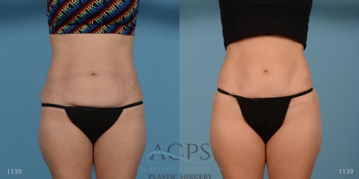 Before & After Liposuction Case 193 Front View: View in Houston, TX