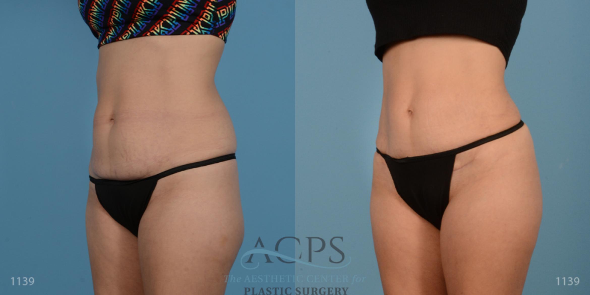 Before & After Liposuction Case 193 Oblique View: View in Houston, TX