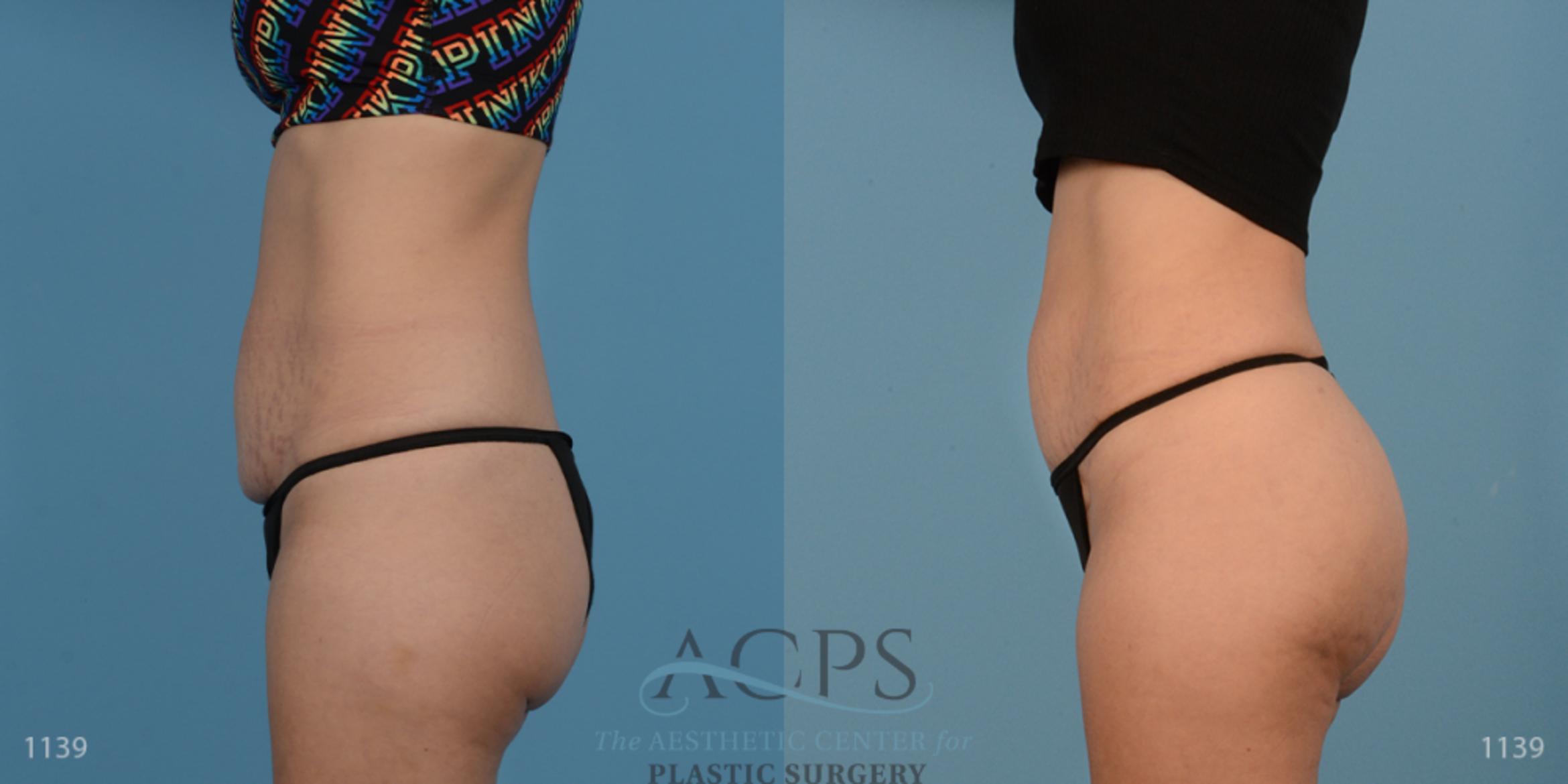 Before & After Liposuction Case 193 Side View: View in Houston, TX