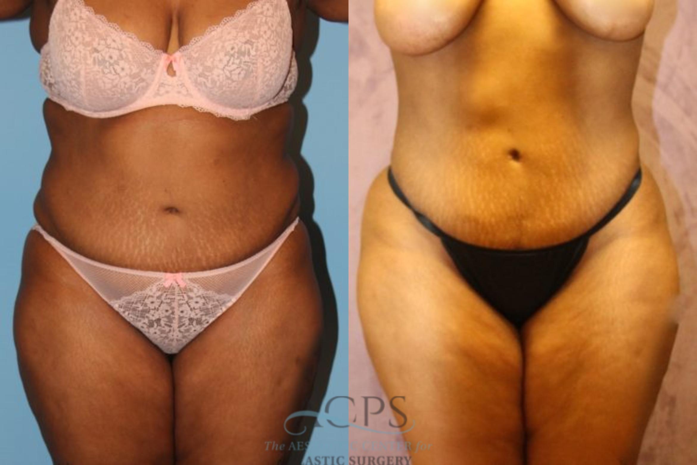 Before & After Liposuction Case 194 Front View: View in Houston, TX