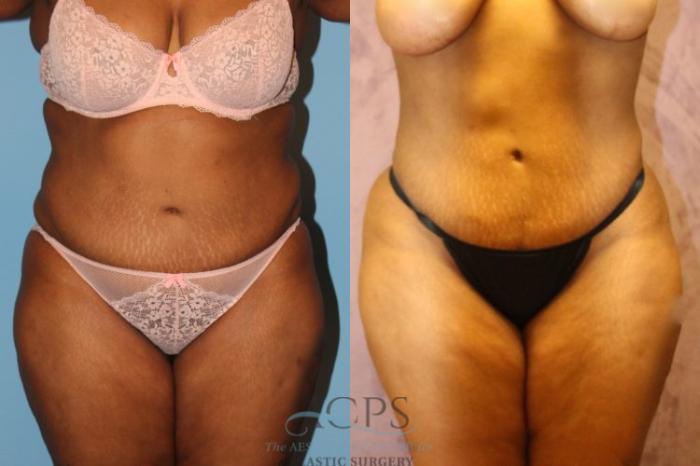 Before & After Liposuction Case 194 Front View: View in Houston, TX