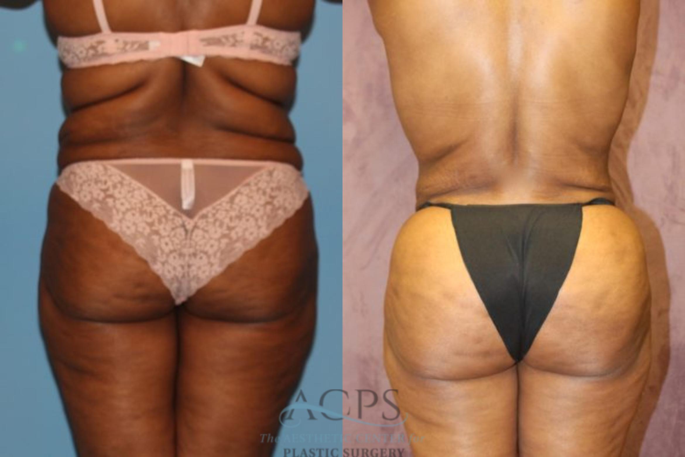 Before & After Liposuction Case 194 Rear View: View in Houston, TX