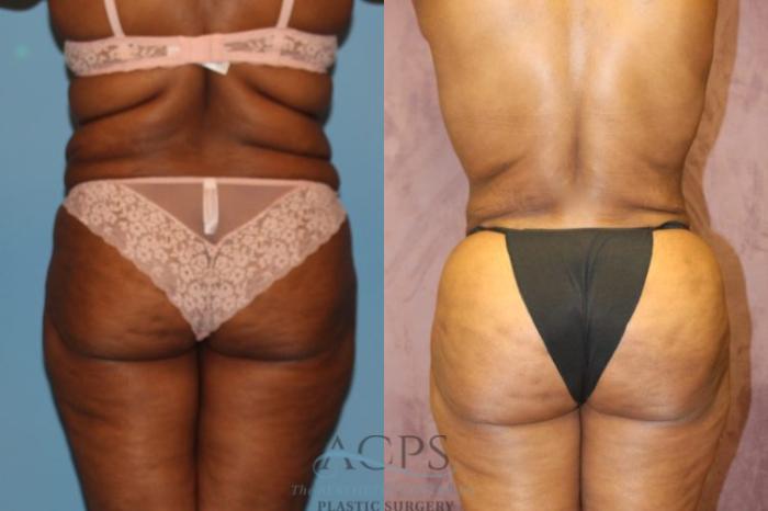 Before & After Liposuction Case 194 Rear View: View in Houston, TX
