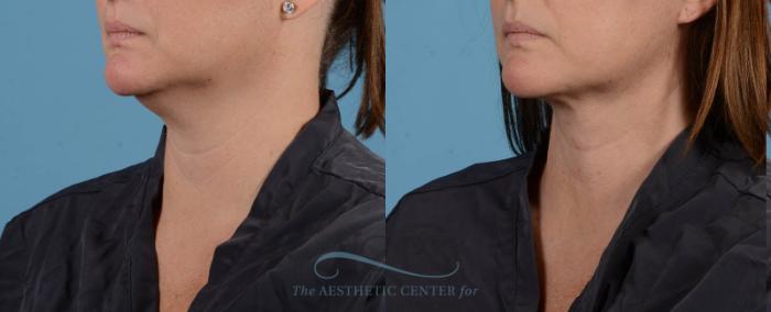 Before & After Liposuction Case 195 Left Oblique View: View in Houston, TX