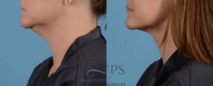 Before & After Liposuction Case 195 Left Side View: View in Houston, TX
