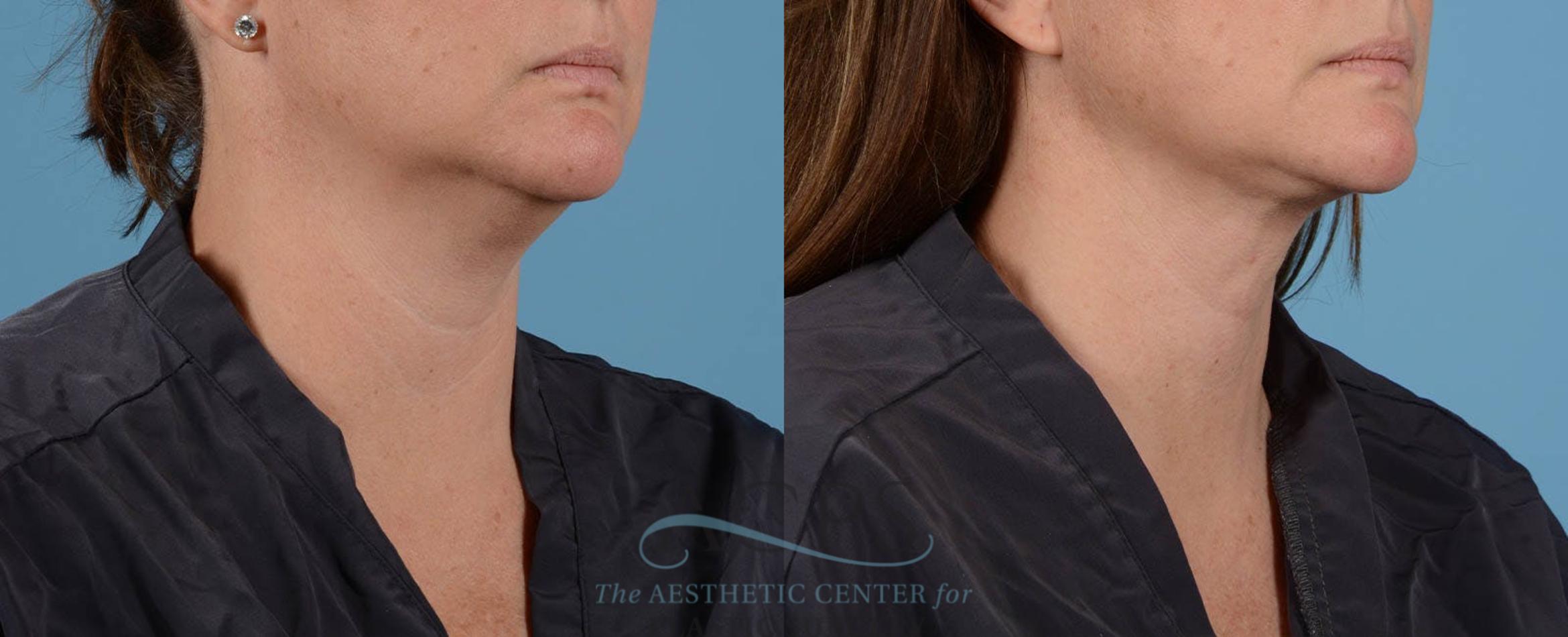 Before & After Liposuction Case 195 Oblique View: View in Houston, TX