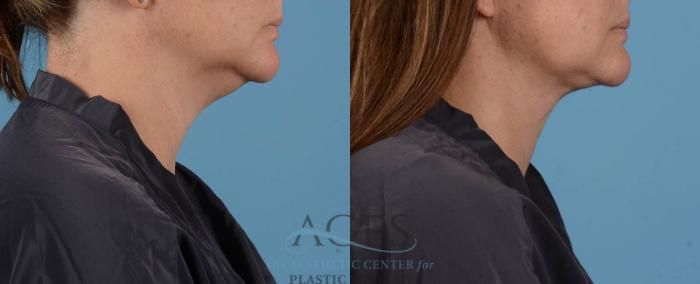 Before & After Liposuction Case 195 Side View: View in Houston, TX