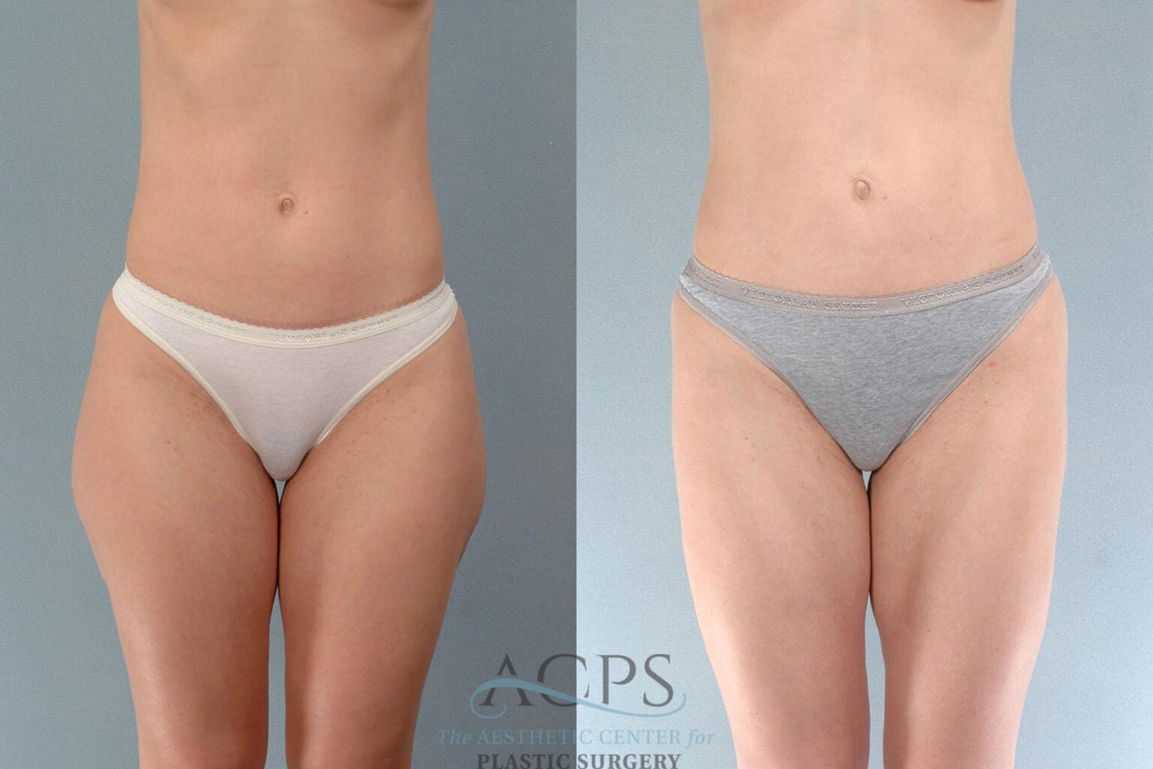 Before & After Liposuction Case 196 Front View: View in Houston, TX