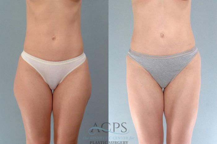 Before & After Liposuction Case 196 Front View: View in Houston, TX