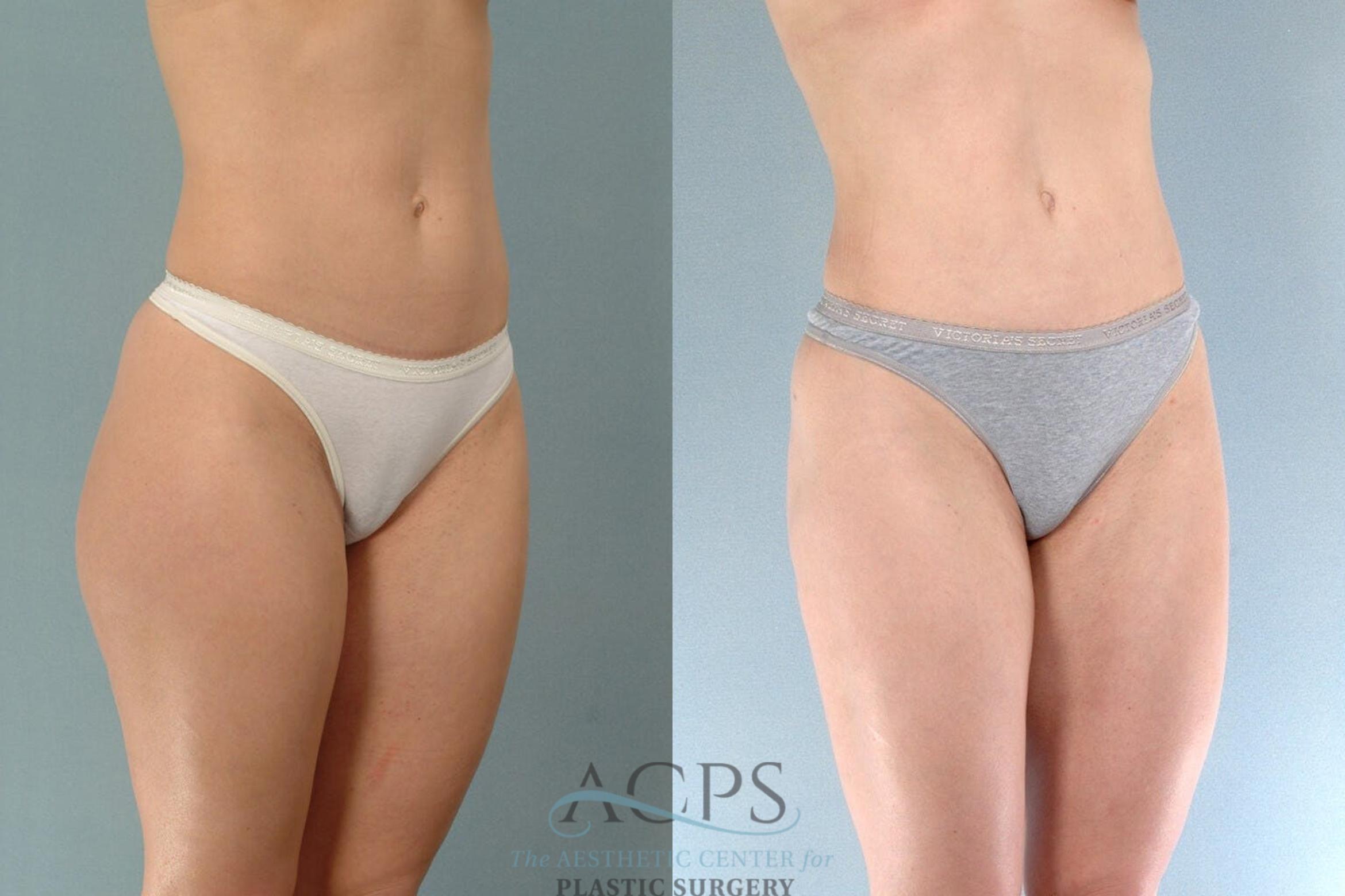 Before & After Liposuction Case 196 Oblique View: View in Houston, TX
