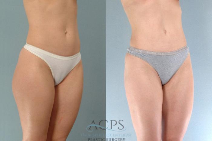 Before & After Liposuction Case 196 Oblique View: View in Houston, TX