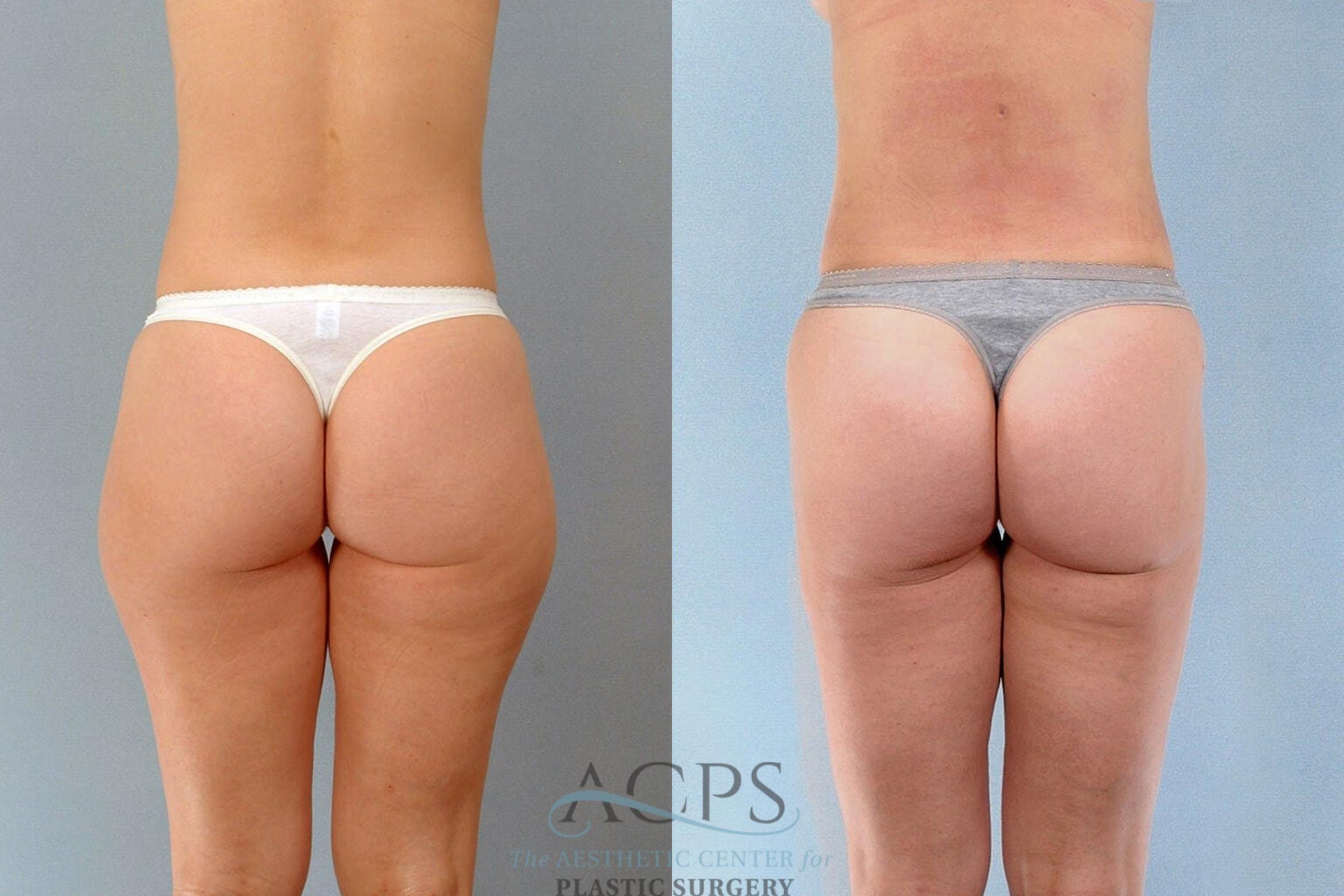 Before & After Liposuction Case 196 Rear View: View in Houston, TX
