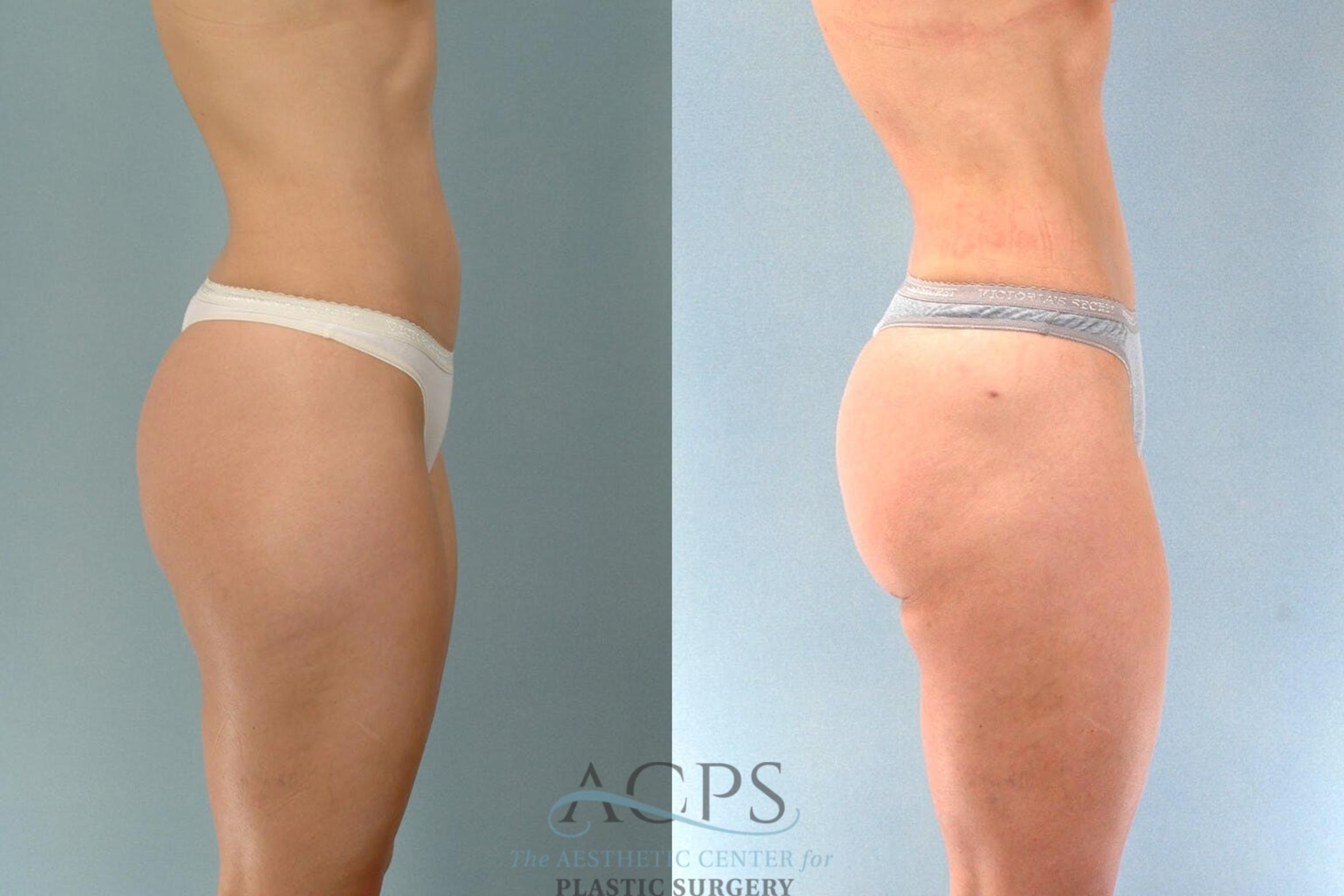 Before & After Liposuction Case 196 Side View: View in Houston, TX