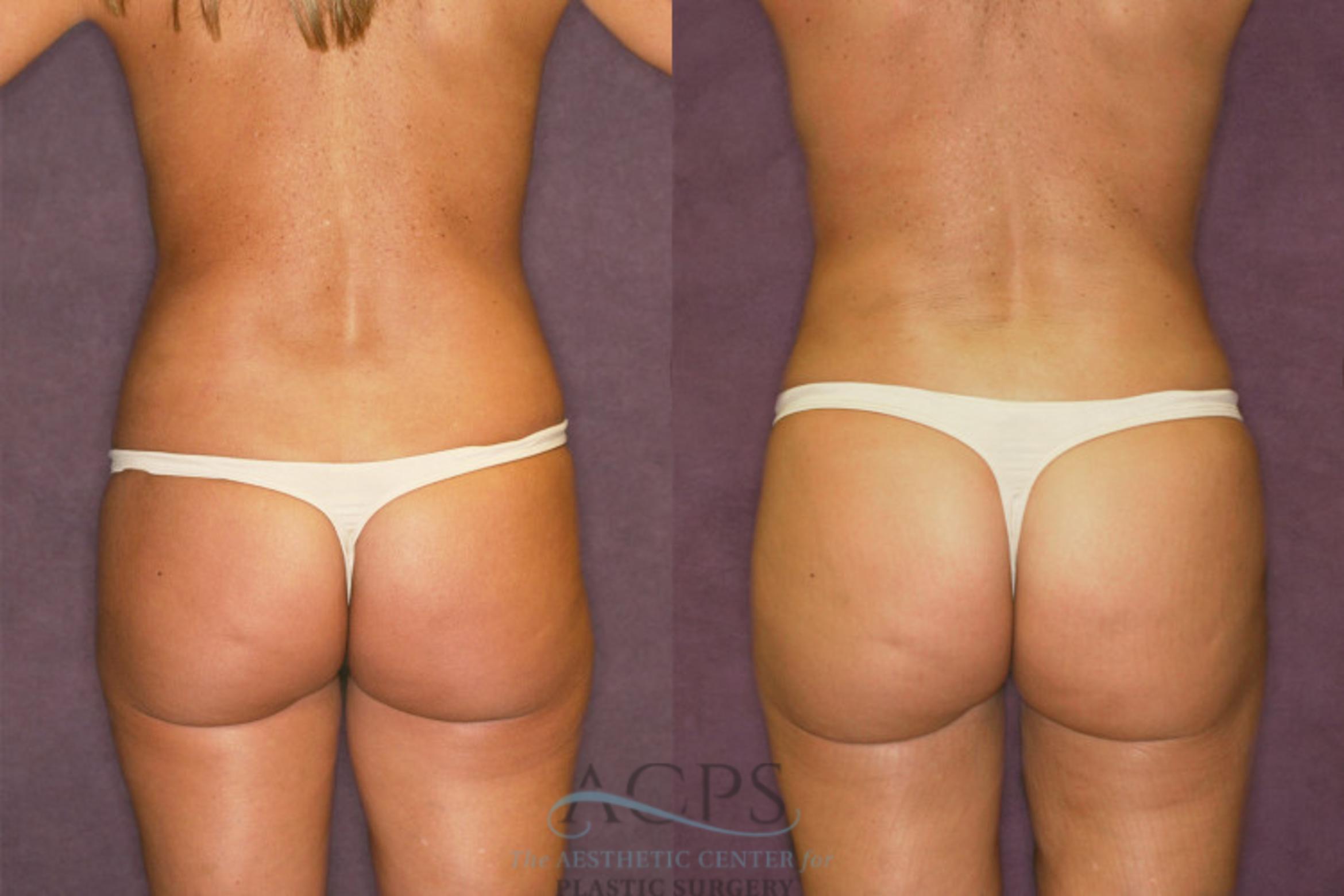 Before & After Liposuction Case 205 Rear View: View in Houston, TX