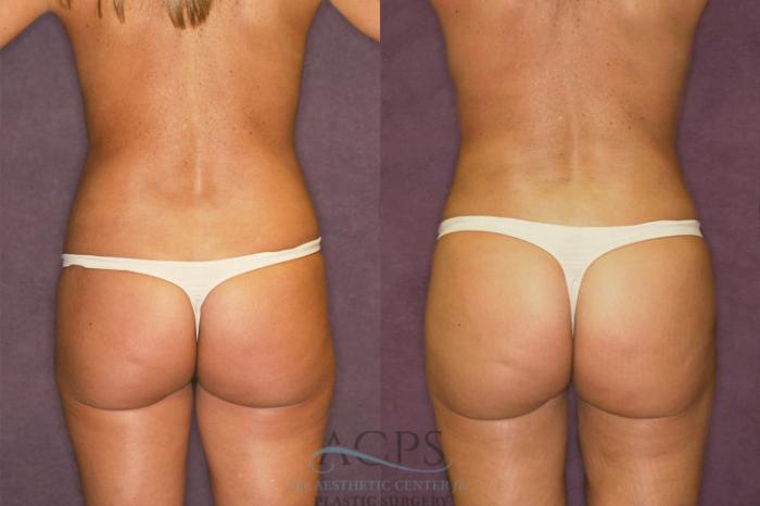 Before & After Liposuction Case 205 Rear View: View in Houston, TX