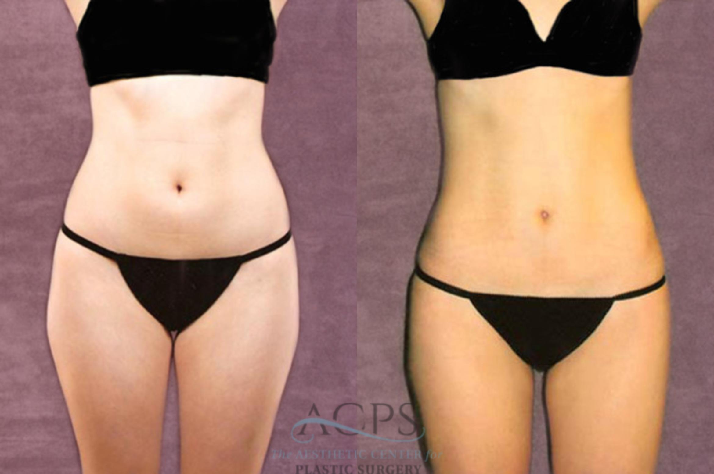 Before & After Liposuction Case 211 Front View: View in Houston, TX
