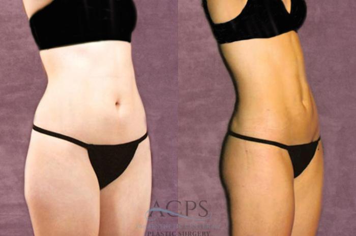 Before & After Liposuction Case 211 Oblique Right View: View in Houston, TX