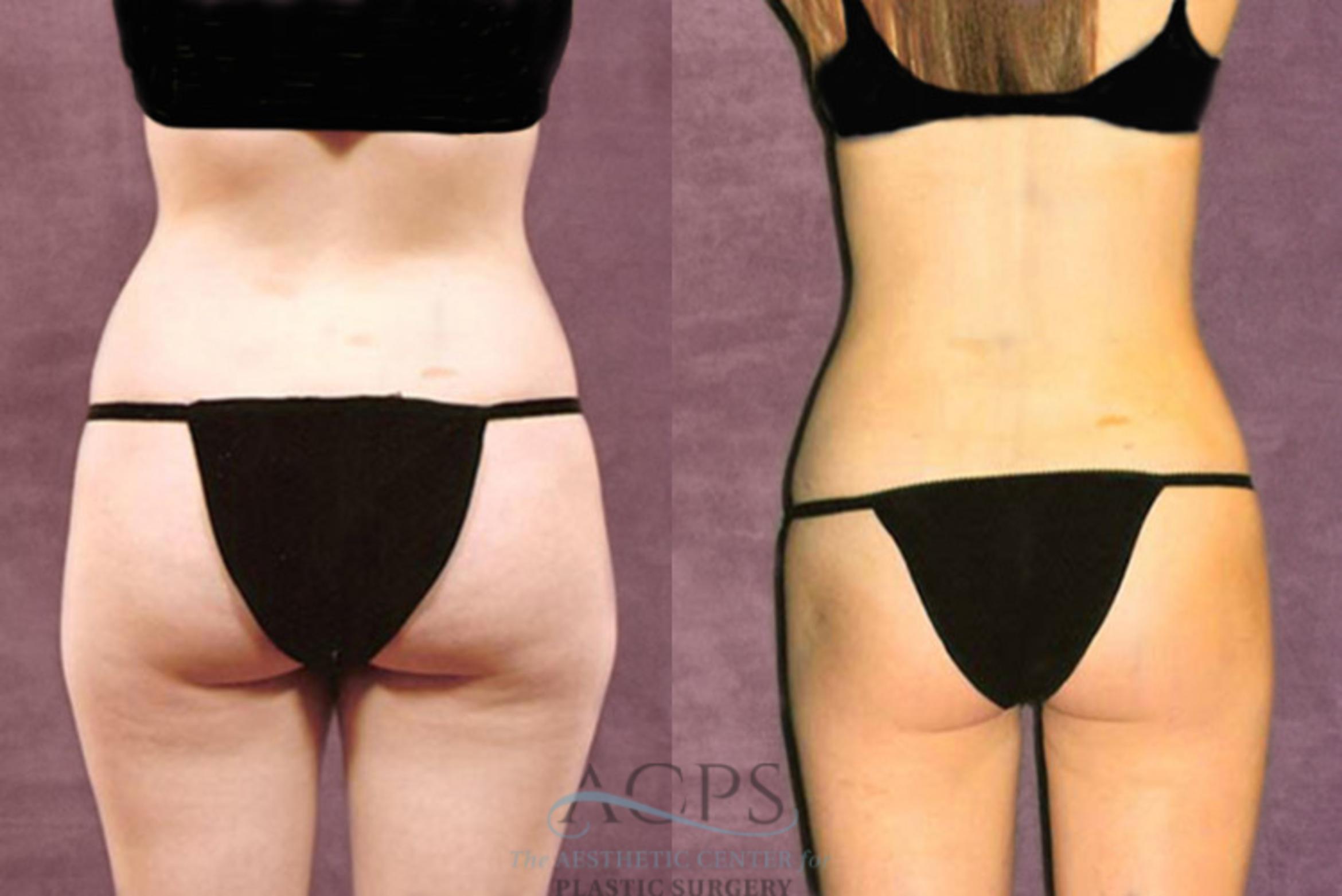 Before & After Liposuction Case 211 Rear View: View in Houston, TX