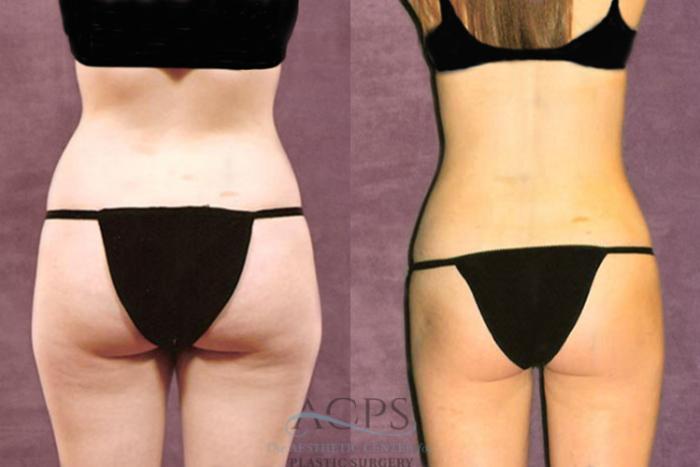 Before & After Liposuction Case 211 Rear View: View in Houston, TX