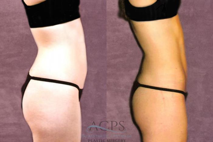 Before & After Liposuction Case 211 Side Right View: View in Houston, TX