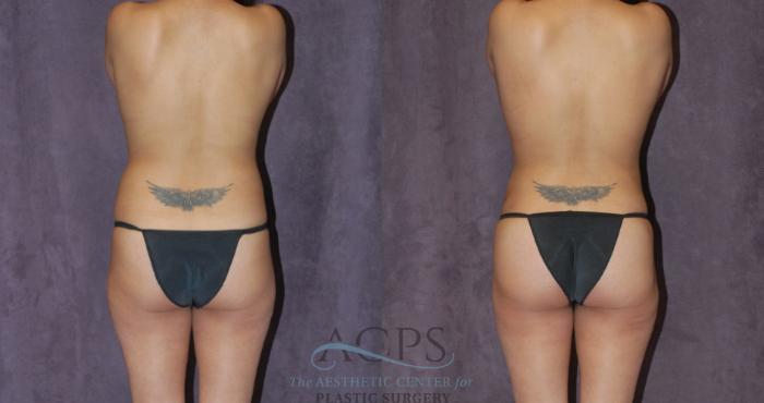 Before & After Breast Augmentation Case 220 Rear View: View in Houston, TX