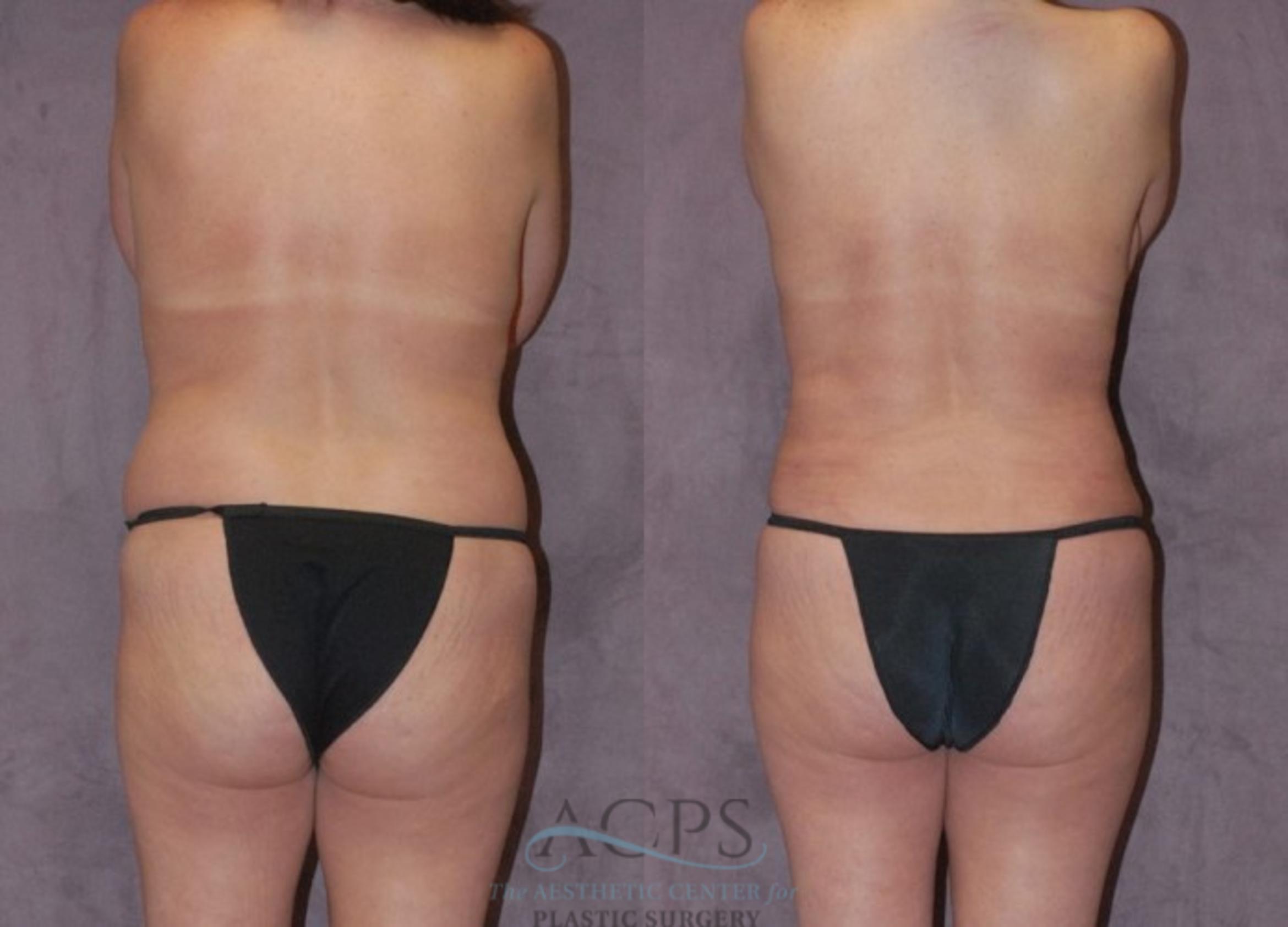 Before & After Liposuction Case 222 Rear View: View in Houston, TX