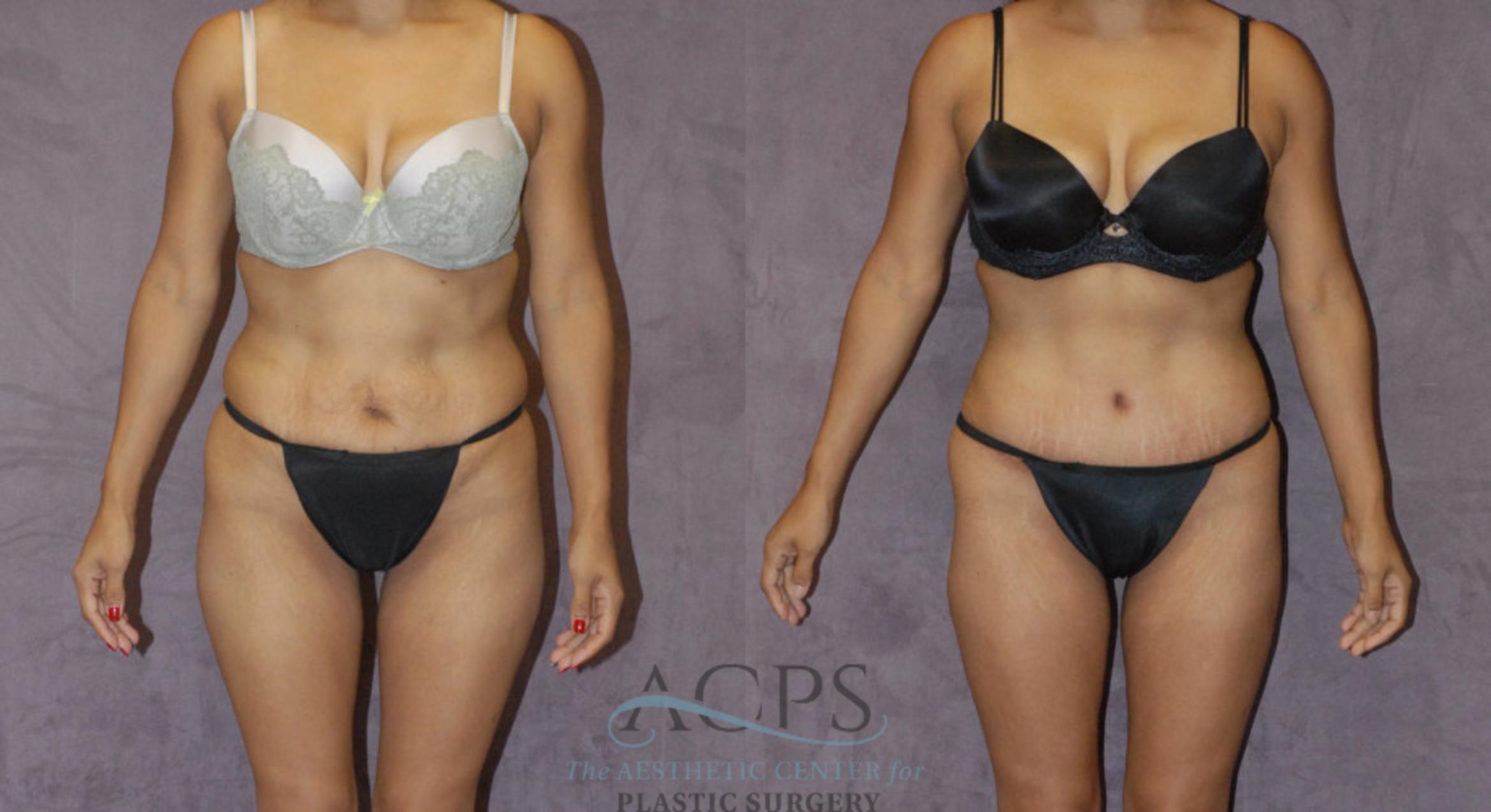 Before & After Liposuction Case 223 Front View: View in Houston, TX