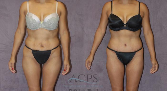Before & After Liposuction Case 223 Front View: View in Houston, TX