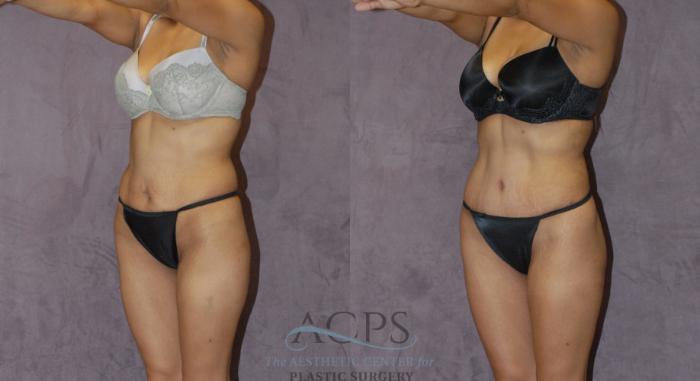 Before & After Liposuction Case 223 Oblique View: View in Houston, TX