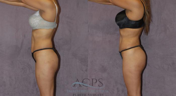 Before & After Liposuction Case 223 Side View: View in Houston, TX