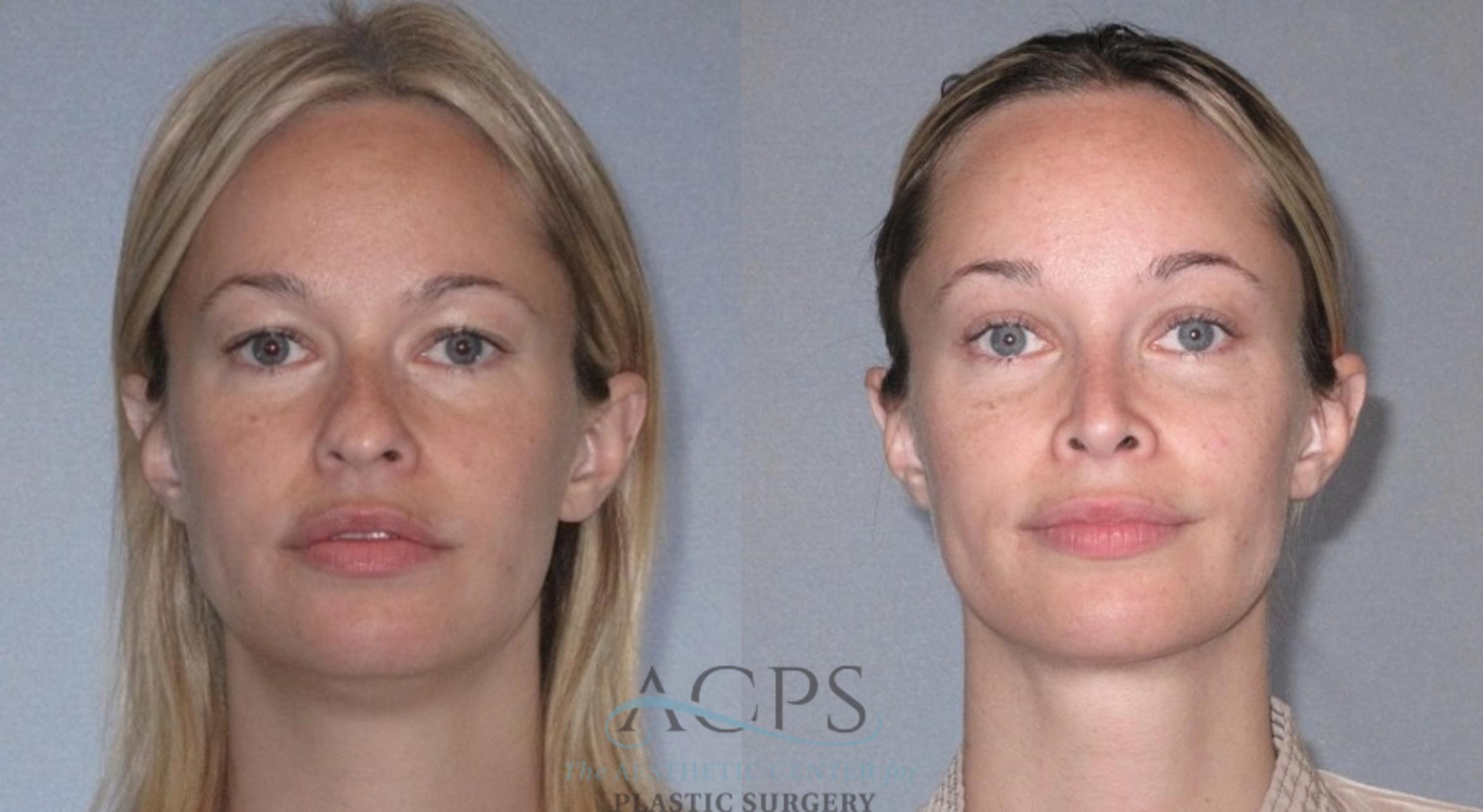 Before & After Liposuction Case 224 Front View: View in Houston, TX