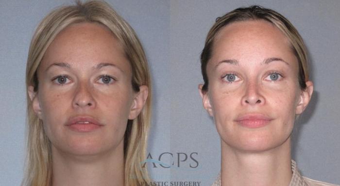 Before & After Liposuction Case 224 Front View: View in Houston, TX