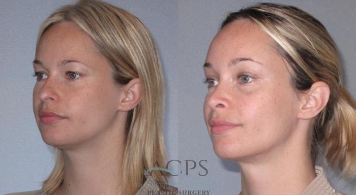 Before & After Liposuction Case 224 Oblique View: View in Houston, TX