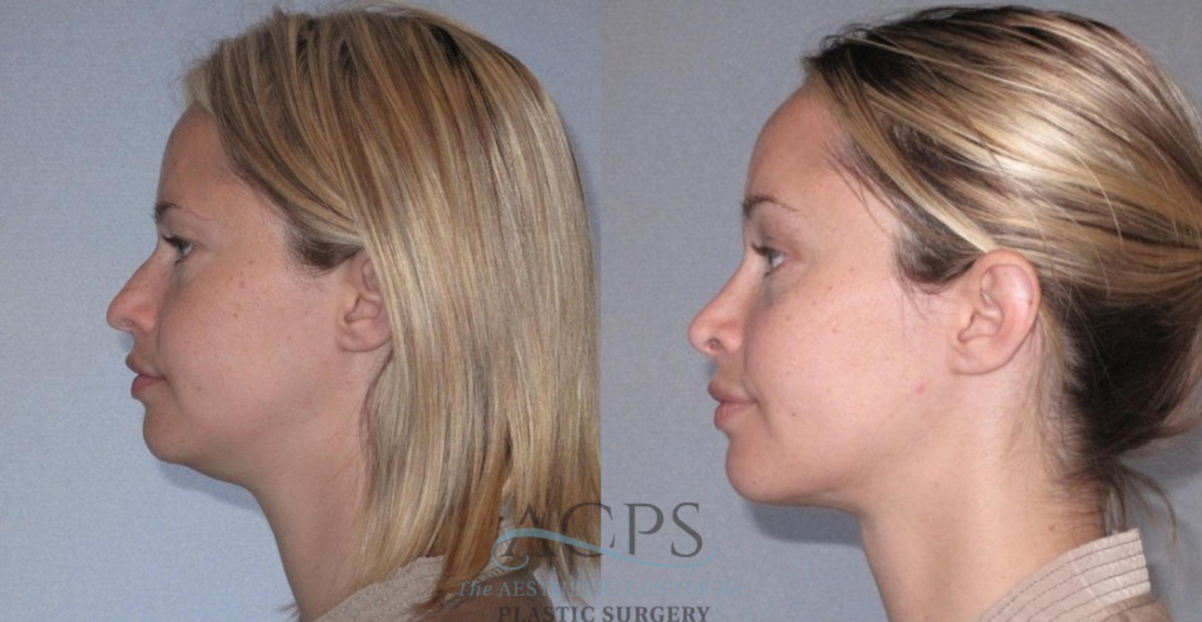 Before & After Liposuction Case 224 Side View: View in Houston, TX